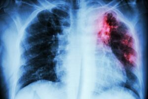 lungs tuberculosis