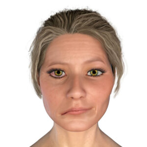 Facial nerve paralysis, Bell's palsy, 3D illustration showing female with one-sided facial nerve paralysis