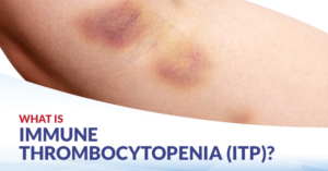 thromobocytopenia'