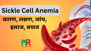 Sickle cell anemia